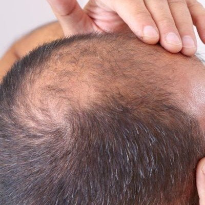 Why is Hair Transplant in Pune the Best Destination?