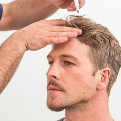 How to Choose the Right Hair Restoration Technique: 2022 Guide