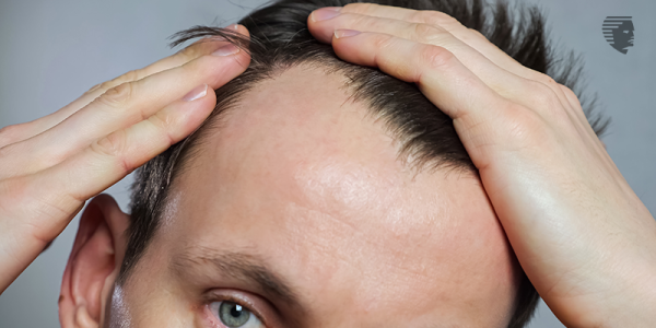 5 Ways To Defeat Your Worst Enemy - Receding Hairline