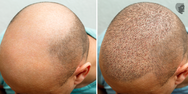 Busting the Myths that Hair Transplant Causes Cancer