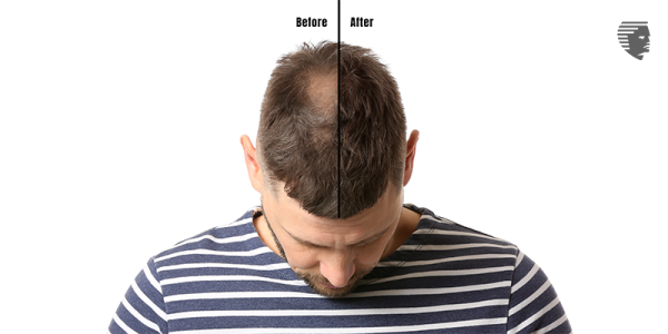 Time Frame of Hair Regrowth