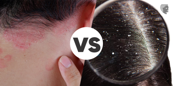 Psoriasis Vs. Dandruff: What are the Signs, Causes, and Treatment