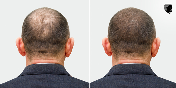Is Hair Transplant a Plastic Surgery