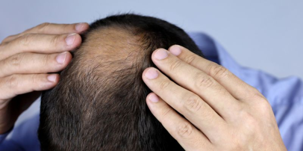 Current Treatments to Stop Balding in Men: The Best Solutions for 2025