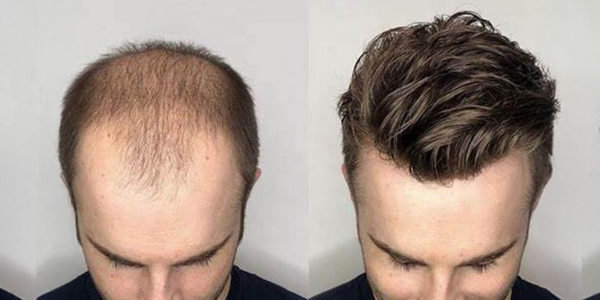 Men's Hair Solutions: How to Choose Between a Toupee and a Wig