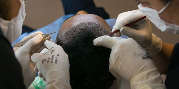 The Best Time for a Hair Transplant: Expert Insights