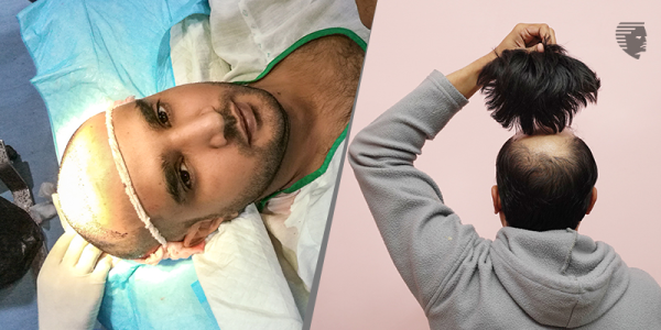Permanent Wigs or Hair Transplant Surgery: Which One Should I choose