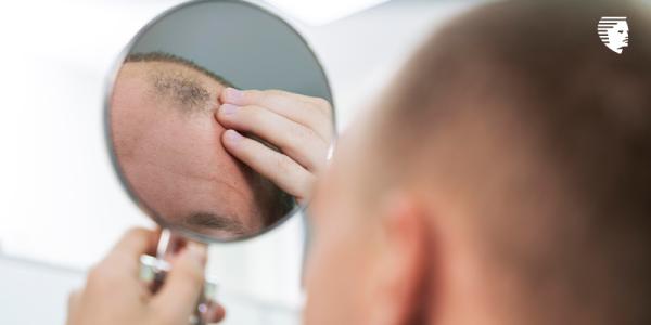 Is My Hair Loss Due to Excessive Sweating