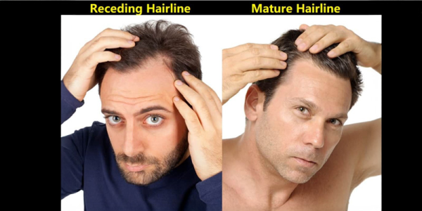 Receding Hairline Vs Mature Hairline