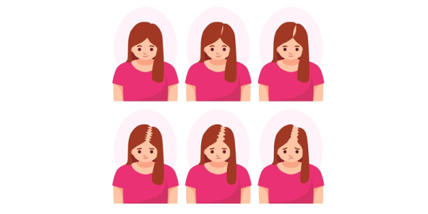 Ludwig Scale and Female Hair Loss: Understanding the Different Stages