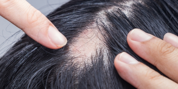 Coping with Hair Loss: Effective Treatments for Alopecia