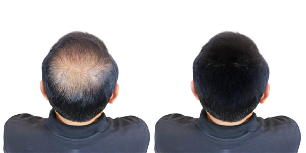 The Men’s Guide to Natural-Looking Hair Replacement