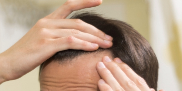 Hair Loss in Teenage Boys: Causes and Effective Solutions