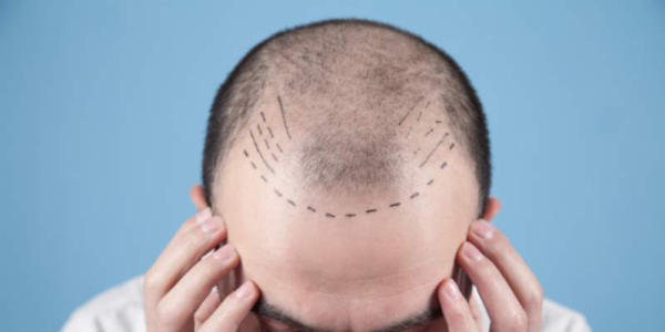 Hair Graft in Hair Transplant Surgery: What You Need to Know